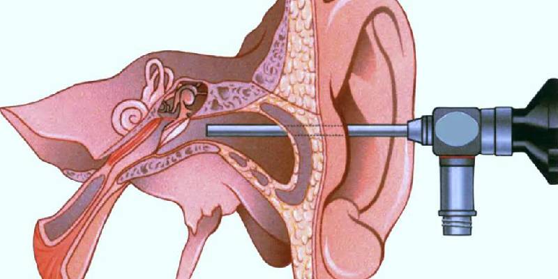 Otoendoscopy in Thane - Ear Endoscopy by Dr. Ankit Singh