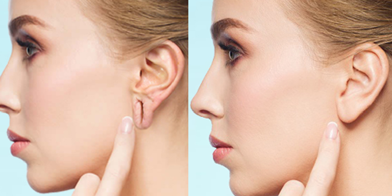Ear Lobe Repair Surgery by Dr. Ankit Singh in Thane