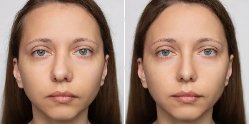 Septoplasty in Thane by ENT Surgeon Dr. Ankit Singh