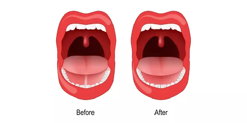 Tongue-tie release in Thane by ENT Specialist Dr. Ankit Singh